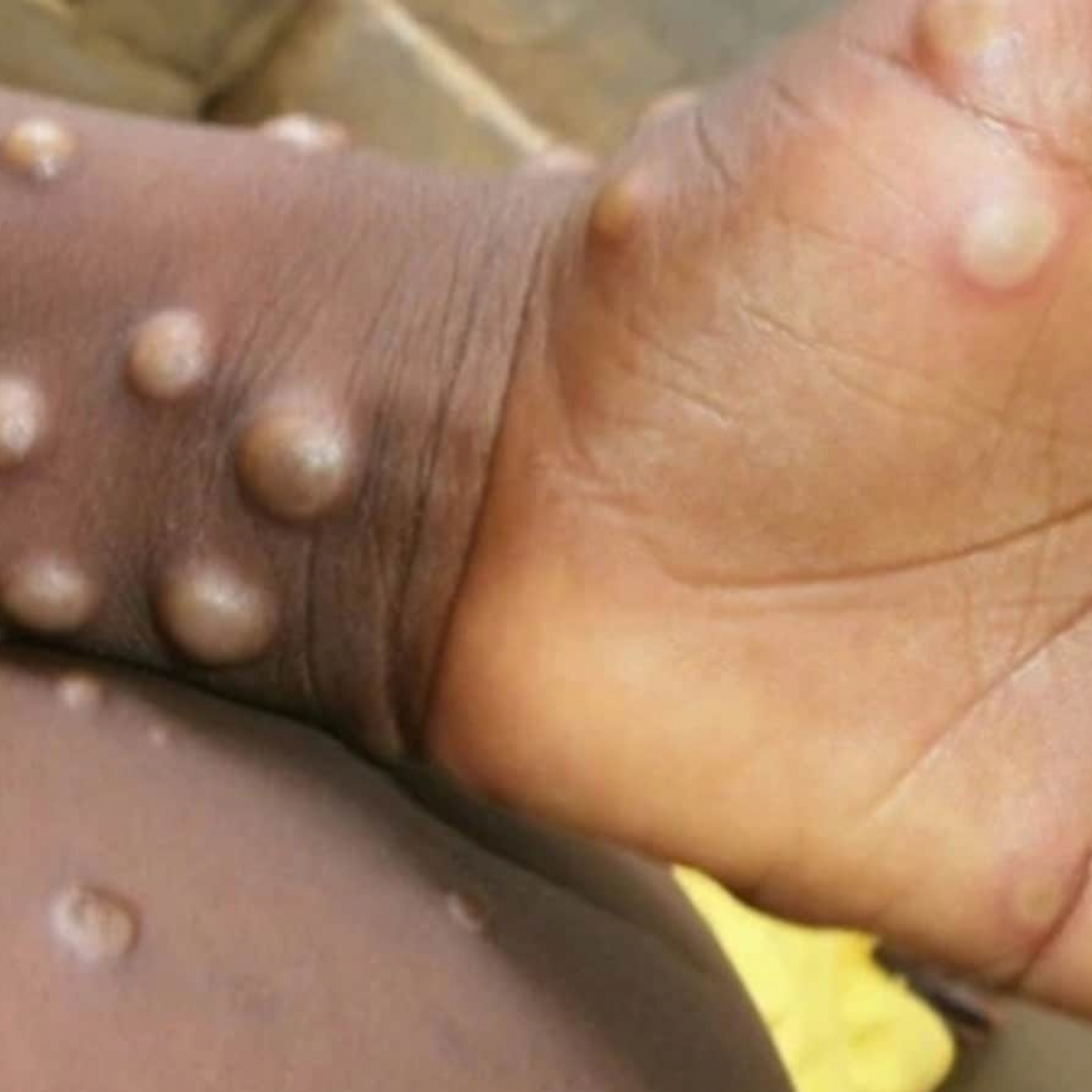 What is monkeypox and where is it spreading