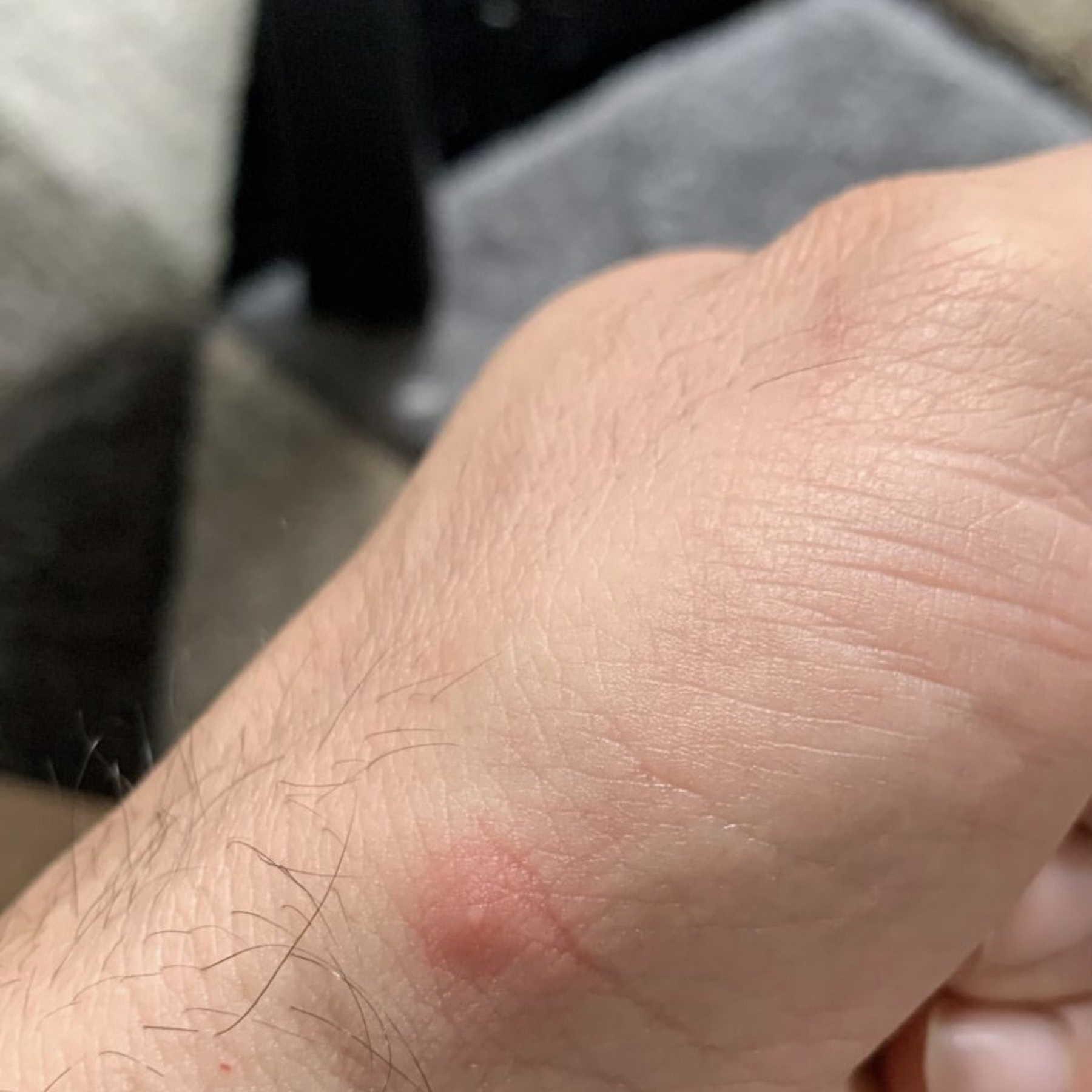 Monkeypox infection detected with help of Instagram. Italian blogger says If I had not seen the video