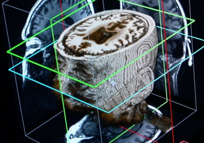 Artificial Intelligence may diagnose dementia in a day