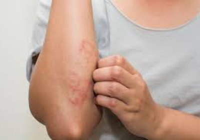 Atopic dermatitis: Know all about the itch that rashes