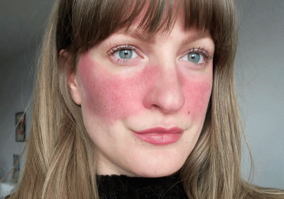 Rosacea: Your skin doesnot define you