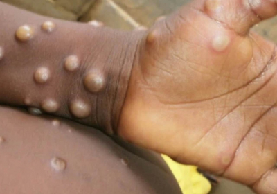 What is monkeypox and where is it spreading