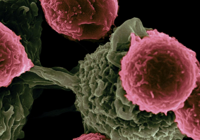 New cancer-fighting discovery identifies patients who respond better to T cell immunotherapy