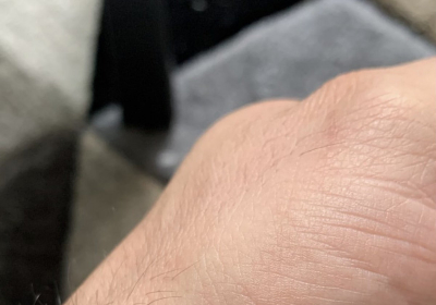 Monkeypox infection detected with help of Instagram. Italian blogger says If I had not seen the video