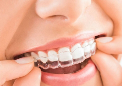What Is Invisalign Treatment