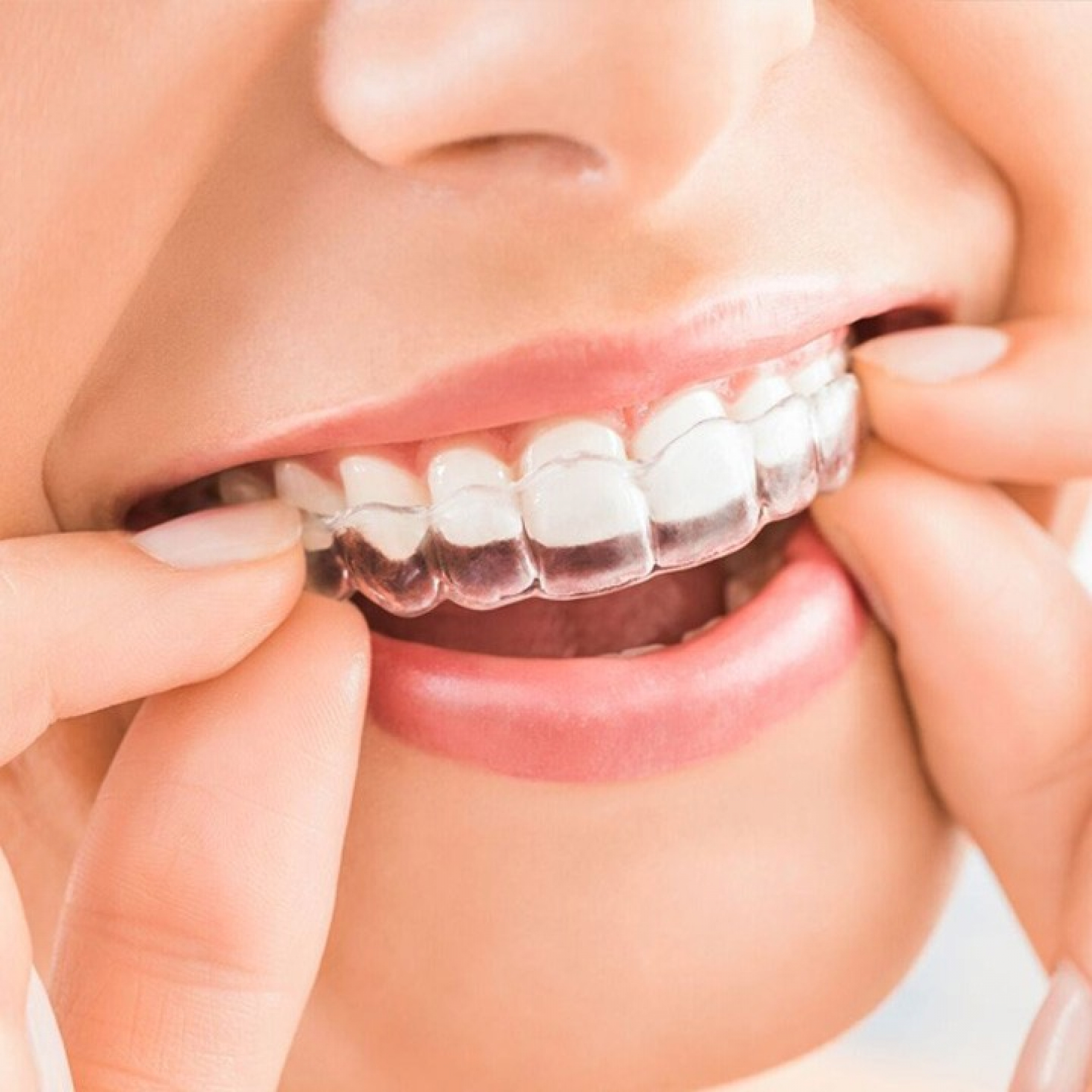 What Is Invisalign Treatment